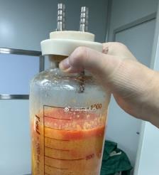 祁东水动力吸脂手术要做多久？